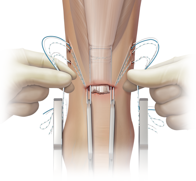 リューシ Arthrex - PARS Tendon Elevator - AR-8860J-01